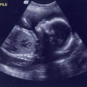 Bebeluşul “MINUNE”! S-a născut după ce a fost avortat