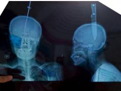 A supravieţuit cu un cuţit imens în cap!