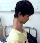 Curiozitate medicală! Tânărul cu CEL MAI LUNG GÂT!