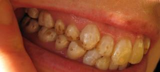 Alimentele care îți înnegresc DINȚII!