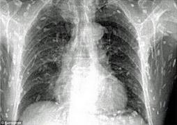 Avea CORPUL INVADAT de VIERMI! Caz medical ŞOCANT!