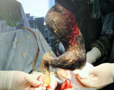ÎNGROZITOR! O bilă de păr de aproape patru kilograme se ascundea în stomacul unei tinere