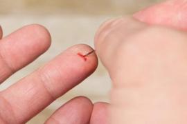 Cum să scoți o așchie de sub piele! Cel mai simplu mod până la ac sau pensetă!