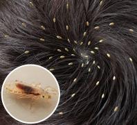 Află ce conține mâncarea ta: INSECTICID anti-păduchi în desertul tău preferat