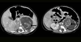 NU E GLUMĂ! O fetiţă de doar trei săptămâni, ÎNSĂRCINATĂ CU GEMENI