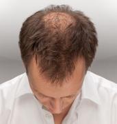 Îți cade părul des? Poți preveni CALVIȚIA cu un singur INGREDIENT din bucătăria ta!