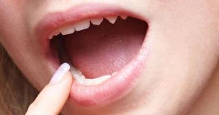 Trăiește în CAVITATEA BUCALĂ și te poate UCIDE