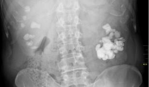 Ai pietre la rinichi? Nu te îngrijora! AŞA poţi scăpa RAPID şi NATURAL de ele