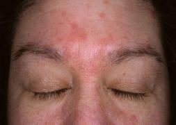 TRUCURI DE MILIOANE! Scapă de petele de pe mâini, gât şi faţă în mod NATURAL