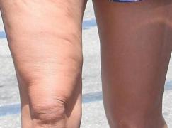 Zațul de cafea, soluție naturală împotriva celulitei