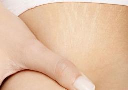 Ai VERGETURI? Încearcă acest ULEI natural