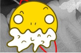 O femeie a trăit cu ASTA doi ani de zile înfiptă în falcă, fără să ştie! Medicii nu vor să o opereze