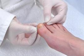 Tratamentul eficient pentru UNGHIA ÎNCARNATĂ