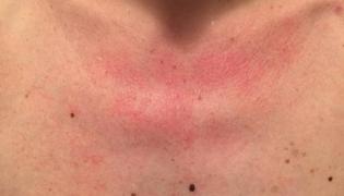 Ai PETE ROȘII pe corp după DUȘ? Ce simptome ascund și cum scapi de ele