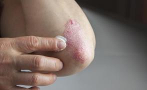 Ți s-a întâmplat? Remediul din bucătărie cu care tratezi eczemele