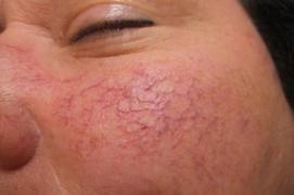 Capilare sparte ori hiperpigmentare a tenului? Cum le poți trata eficient acasă