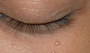 Scapă de PUNCTELE NEGRE și ALBE de pe față simplu și natural