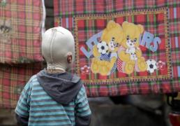 I se spune"BĂIATUL CU MASCĂ". Povestea impresionantă a unui copil mutilat