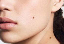 Vrei să vezi dacă te expui cancerului de piele? Testează-şi gratuit aluniţele în cadrul campaniei "Un viitor fără pată”