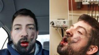 Imagini CUTREMURĂTOARE! Un tânăr s-a ales cu dinţii scoşi, după ce a fumat din ŢIGARA ELECTRONICĂ! Cum a fost posibil