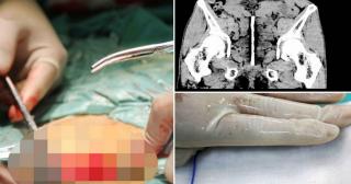 CU PIXU-N ORGAN! Un bărbat de 59 de ani a ŞOCAT medicii din Roman. A stat mai bine de o săptămână cu un pix înfipt în PENIS!