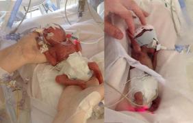 LUPTĂ INCREDIBILĂ PENTRU VIAȚĂ: două gemene s-au născut prematur, la NICI MĂCAR 6 LUNI. Cântăreau fiecare doar UN KILOGRAM!