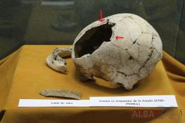 Descoperire HALUCINANTĂ în Munții Apuseni. Cineva a făcut o operaţie pe creier acum 4.500 de ani, iar pacienta a supravieţuit! Există dovezi