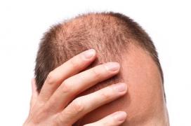 S-a descoperit că bărbaţii moştenesc chelia de la mame