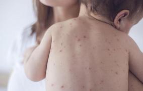 Bulgarii, speriaţi de EPIDEMIA DE RUJEOLĂ din România. Ce măsuri iau autorităţile de la Sofia