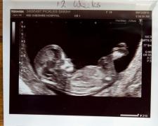 COPILUL-MIRACOL! O tânără vindecată de CANCER, despre care medicii credeau că e INFERTILĂ după chimioterapie, a rămas însărcinată