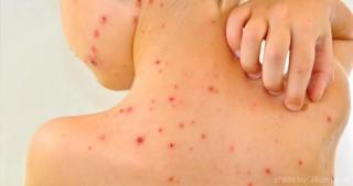 EPIDEMIE de RUJEOLĂ. din cauza nevaccinării! Peste 700 de noi cazuri raportate numai în ultimele zile!