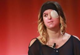 MUTILATĂ pe viaţă! Fosta finalistă Miss Italia îşi arată chipul DESFIGURAT după ce a fost stropită cu acid de fostul iubit: "Asta nu e iubire"