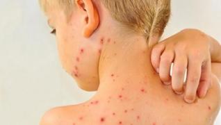 CIFRĂ ÎNSPĂIMÂNTĂTOARE de noi cazuri de rujeolă, în ultimele 7 zile, în România. S-a ajuns la 30 de morţi