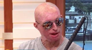 MĂRTURIA cutremurătoare a unui ROMÂN DESFIGURAT de logodnica sa, care i-a turnat în cap o sticlă de ACID SULFURIC, în timp ce dormea: “Câte vieți trebuie să fie distruse?“ (VIDEO)