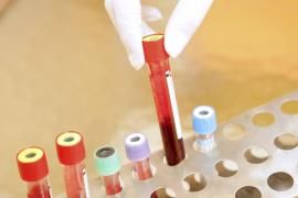 Descoperire uriaşă în medicină! Cancerul ovarian ar putea fi detectat cu un simplu test de sânge