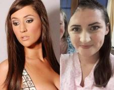 Poveste tulburătoare! Un fotomodel a rămas cu o GAURĂ imensă în craniu, după ce a căzut pe scări. După șapte operații pe creier, craniul i-a fost refăcut cu ajutorul tehnologiei 3D (FOTO)