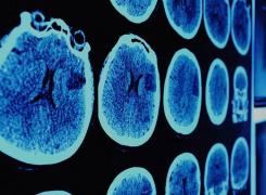 Descoperire crucială a cercetătorilor în lupta împotriva cancerului!