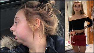 Jodie Bowers, operație de modificare a maxilarului