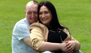 Românul desfigurat cu acid de logodnică, în Anglia, şi-a găsit sufletul pereche