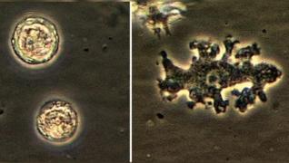 Femeie care câștiga lupta cu cancerul la sân, infectată cu o bacterie mâncătoare de creier uman, în Seattle