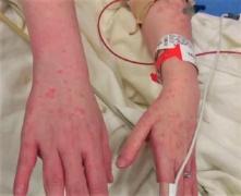 O boală extrem de rară, care poate fi  mortală, a fost descoperită la Bacău. Iniţial, afecţiunea se manifestă ca o gripă banală