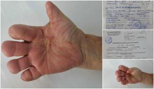 Șeful Chirurgie Plastică SJU Brașov a răbufnit: "Regret că nu i-am tăiat mâna, ca să-i dea ăștia o amărâtă de pensie"