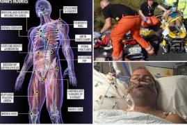 Minune medicală. Un motociclist a supraviețuit după un impact devastator cu un Mercedes. Bărbatul avea pelvisul rupt în 29 de bucăți, 18 coaste rupte și sternul fracturat