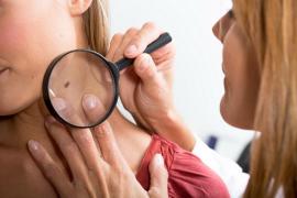 Tratament pentru cancerul de piele