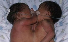 Gemenele siameze la naștere