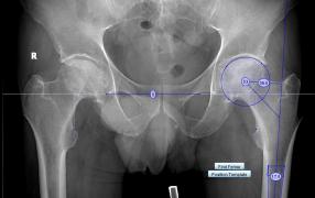 Radiografia unei operații la șold
