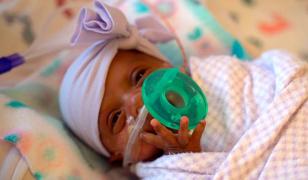 Povestea bebeluşului de 250 de grame care a uimit întreaga lume