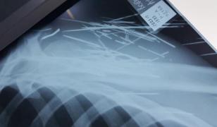 Medic din Botoşani, îngrozit după ce a făcut o radiografie unui pacient