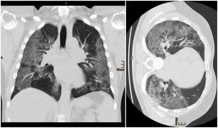 Cum arată radiografia la plămâni a unui medic infectat cu Covid-19