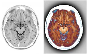 Un bărbat care suferea de convulsii misterioase a fost diagnosticat cu un parazit care trăia în creierul lui de zeci de ani